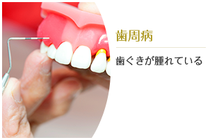 歯周病：歯ぐきが腫れている