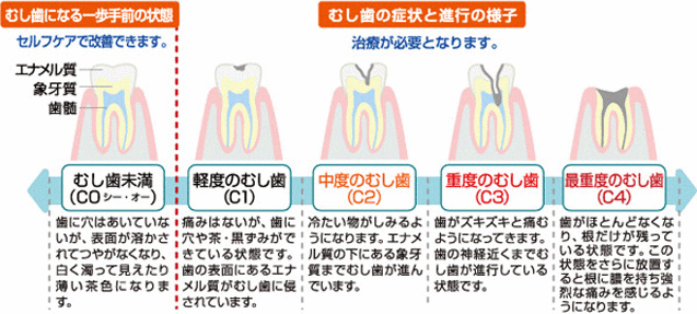 むし歯の進行について